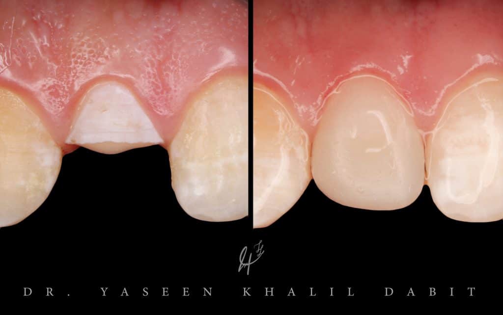 complicated crown fructure