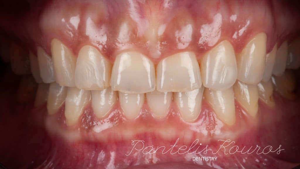 ICP- Finalized ortho-treatment