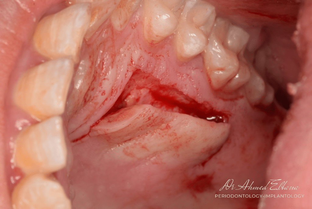 Donner site preparation