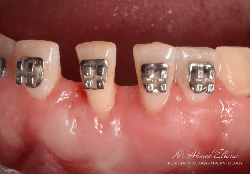 Orthodontic treatment