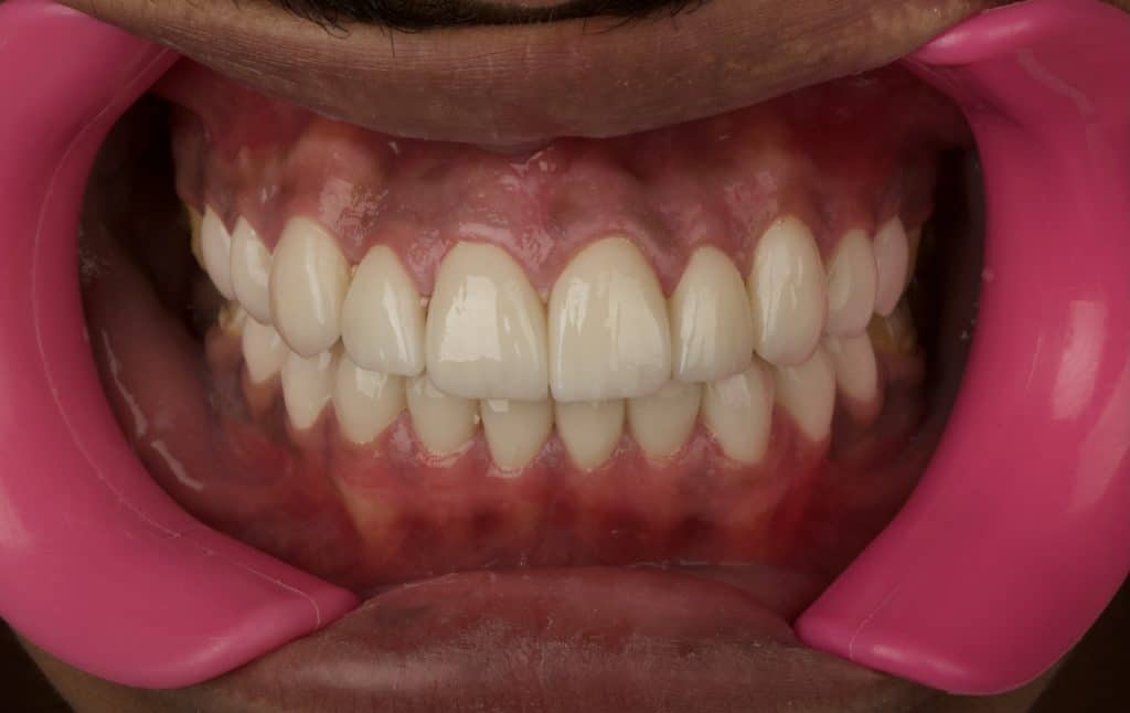 Final results 3 days after cementation