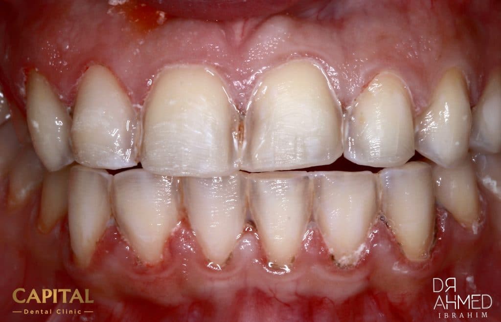 After veeners removal