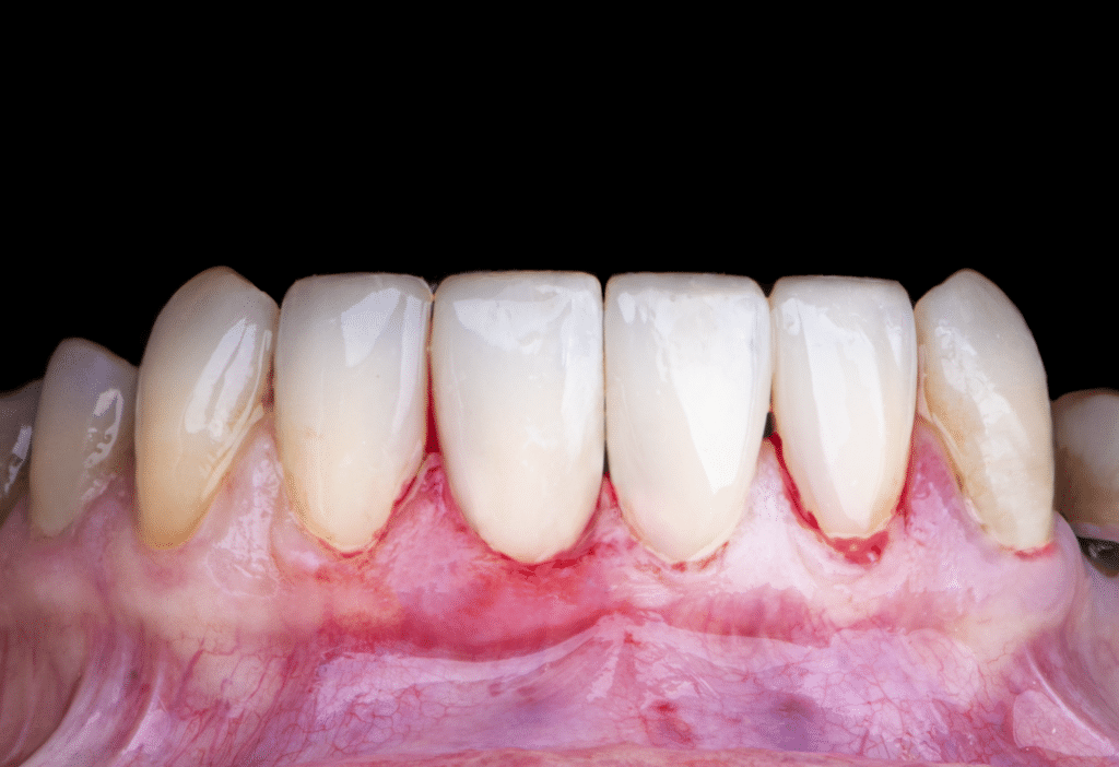 Multiple Diastema C2
