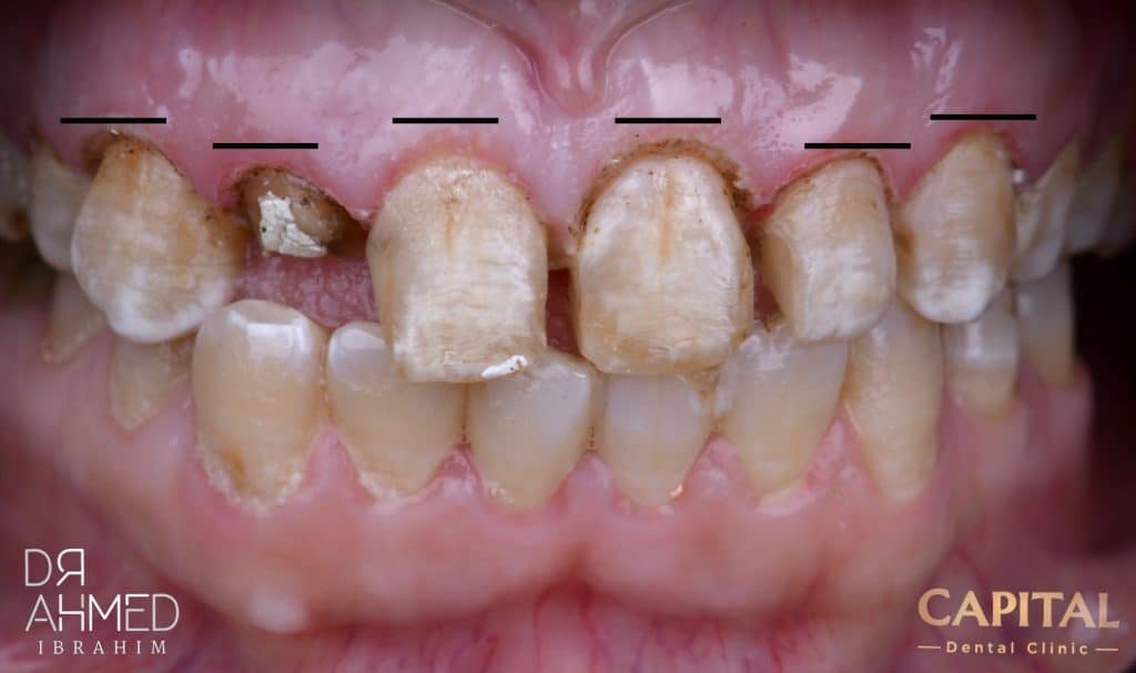 After laser gingival contouring