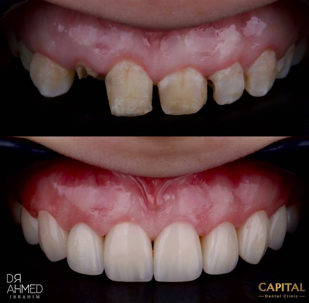 Initial situation vs immediately after cementation