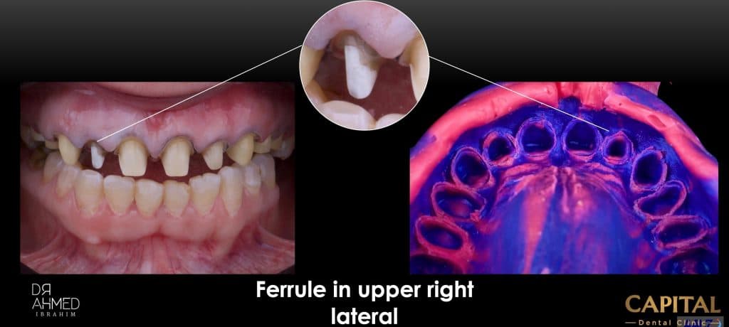 Preparation and impression
