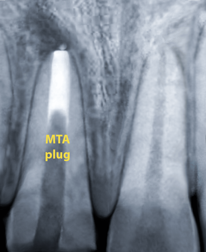 Case Cental full Build up E X-ray