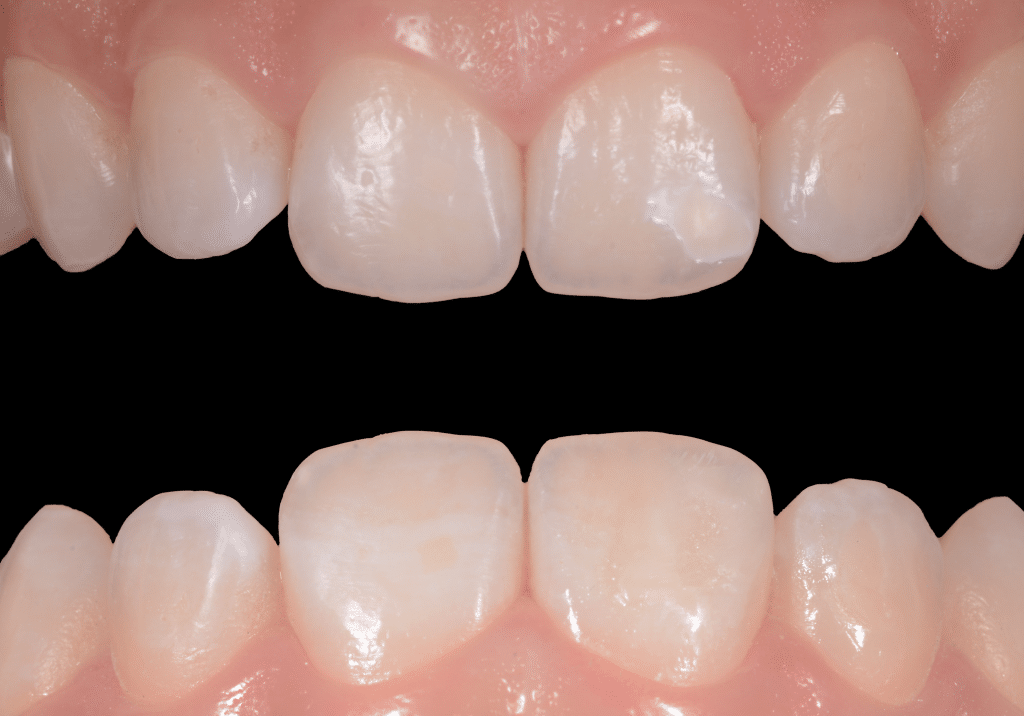 White-spot lesion treatment with a combination of ICON infiltrant and ...