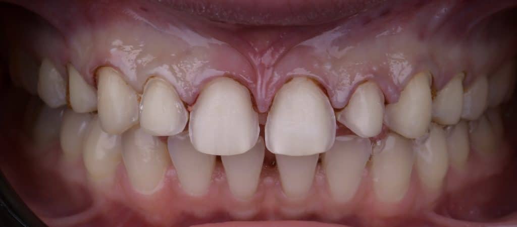 After veener removal and adjusting preparation