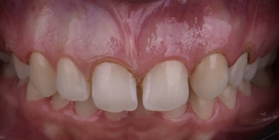 After laser gingival contouring