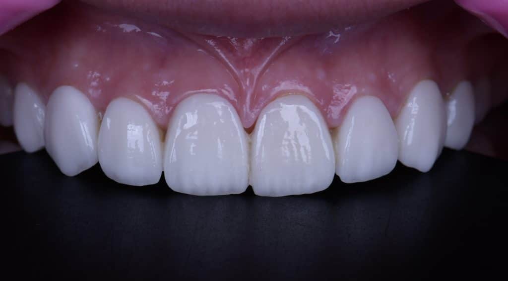After laser disinfection and gingival contouring