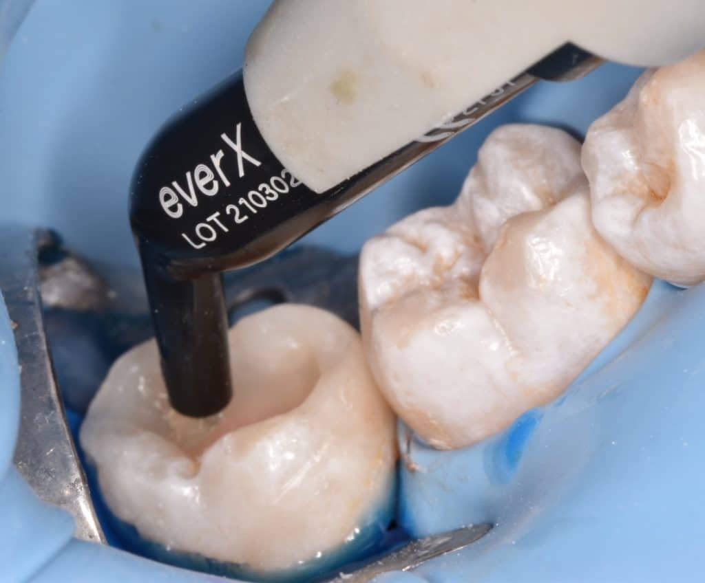 thumbnail image 2 of GC Ever X Flow High Strength Posterior Fiber Reinforced Composite Resin - Dentine 2 of 5