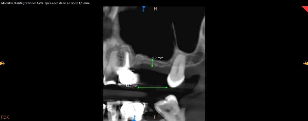 CBCT