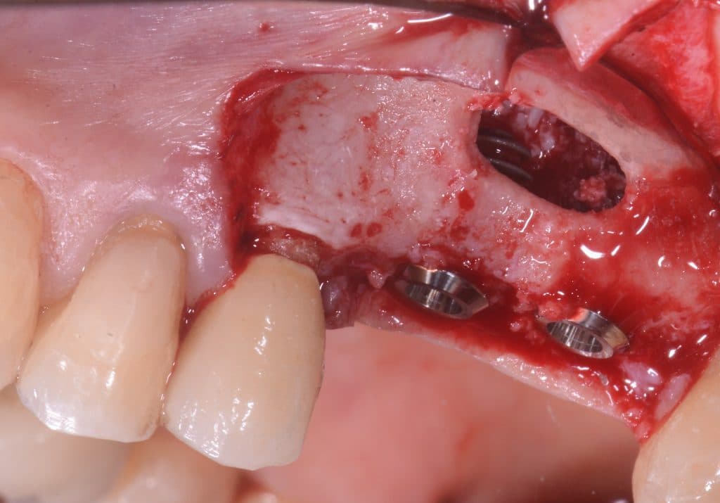 implant insertion view from the lateral window