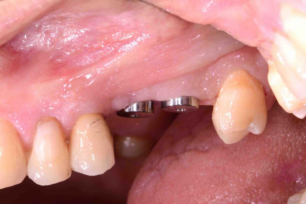 one month follow-up 2