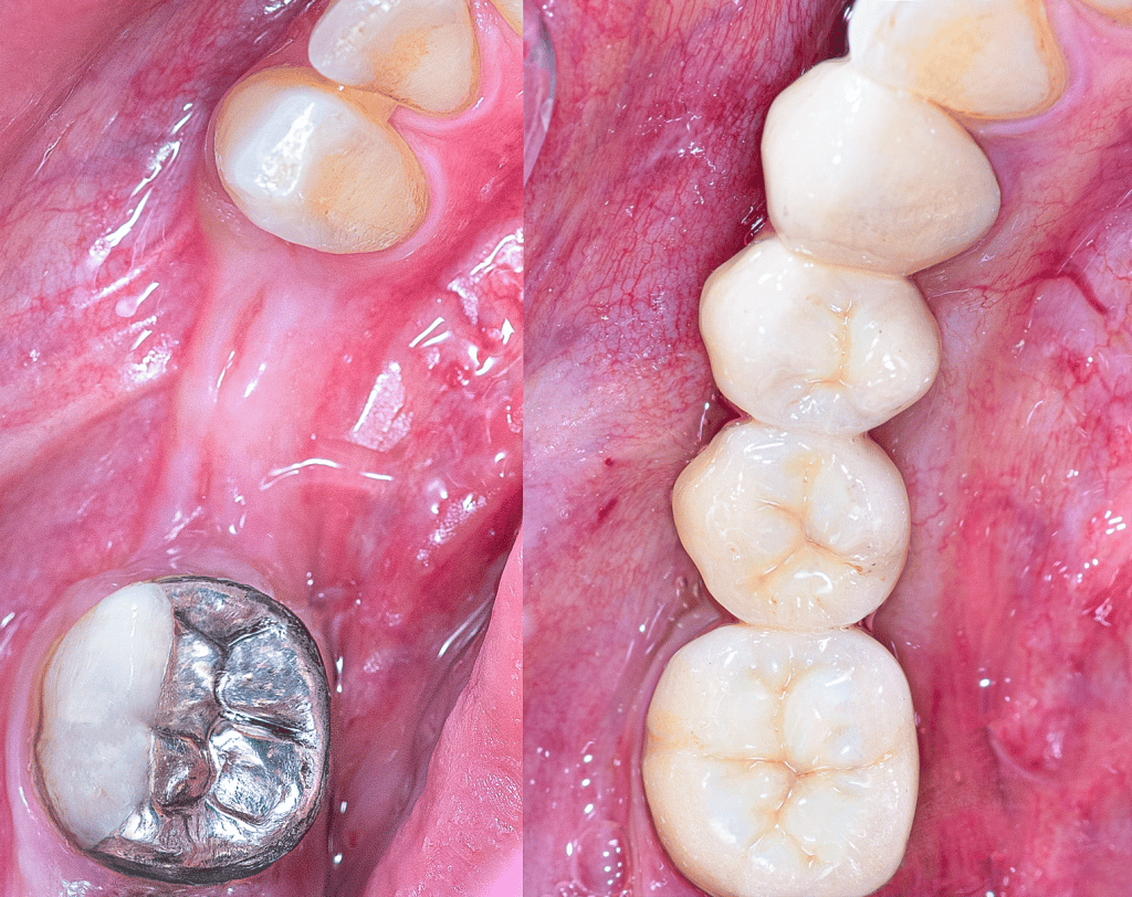 Before and after occlusal