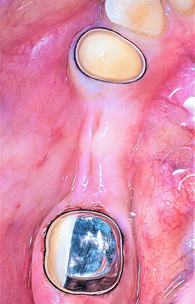 Case Prep with amalgam