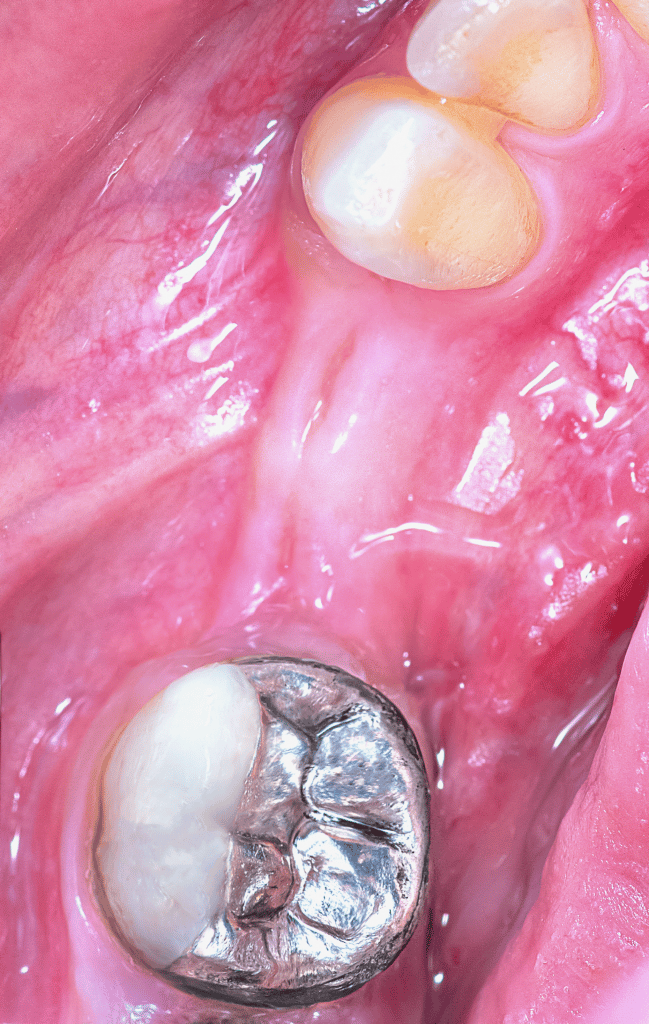 Case Prep with amalgam A before