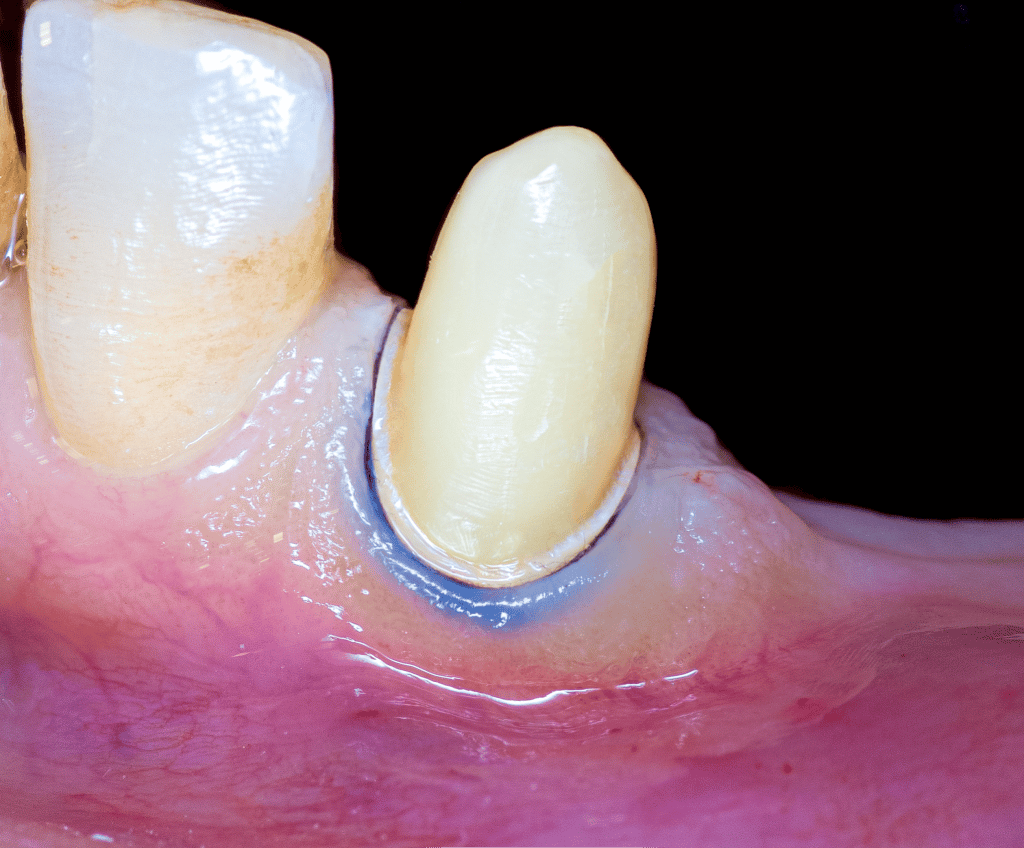 Case Prep with amalgam Canine frontal view