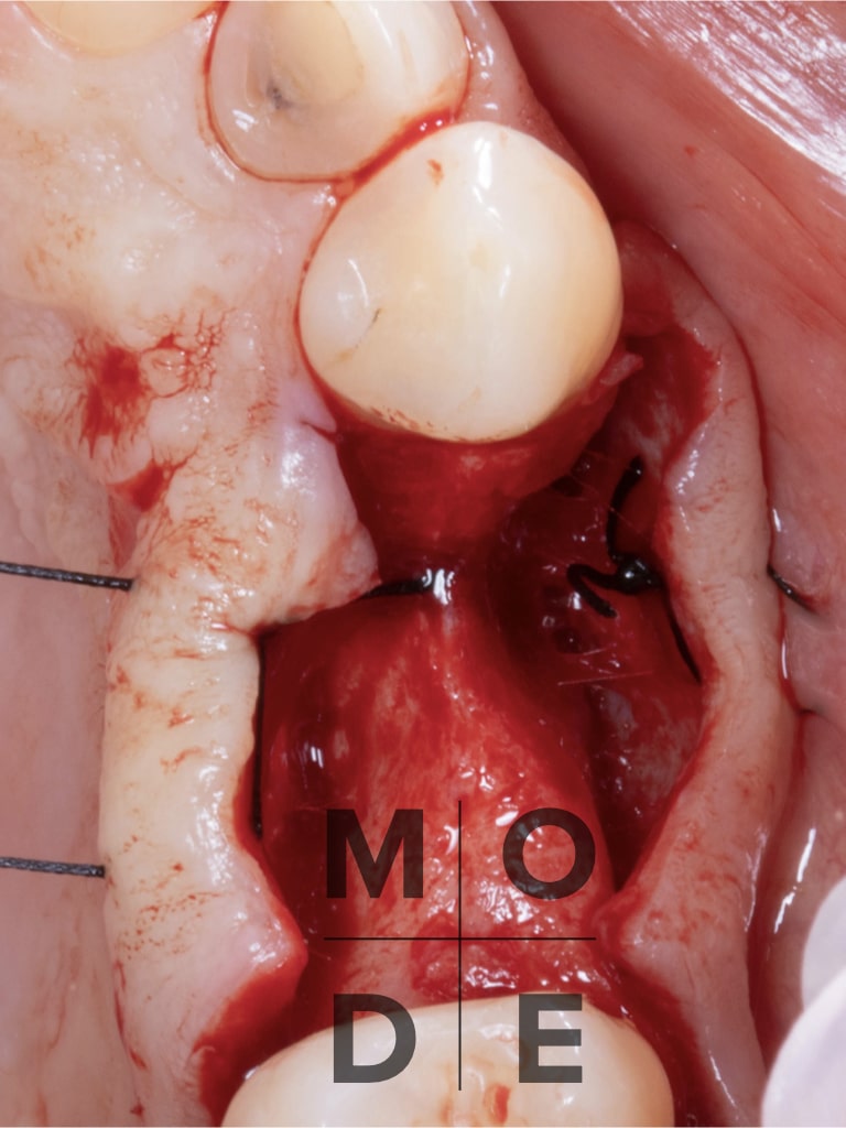 Vertical and Horizontal Defect at tooth 14