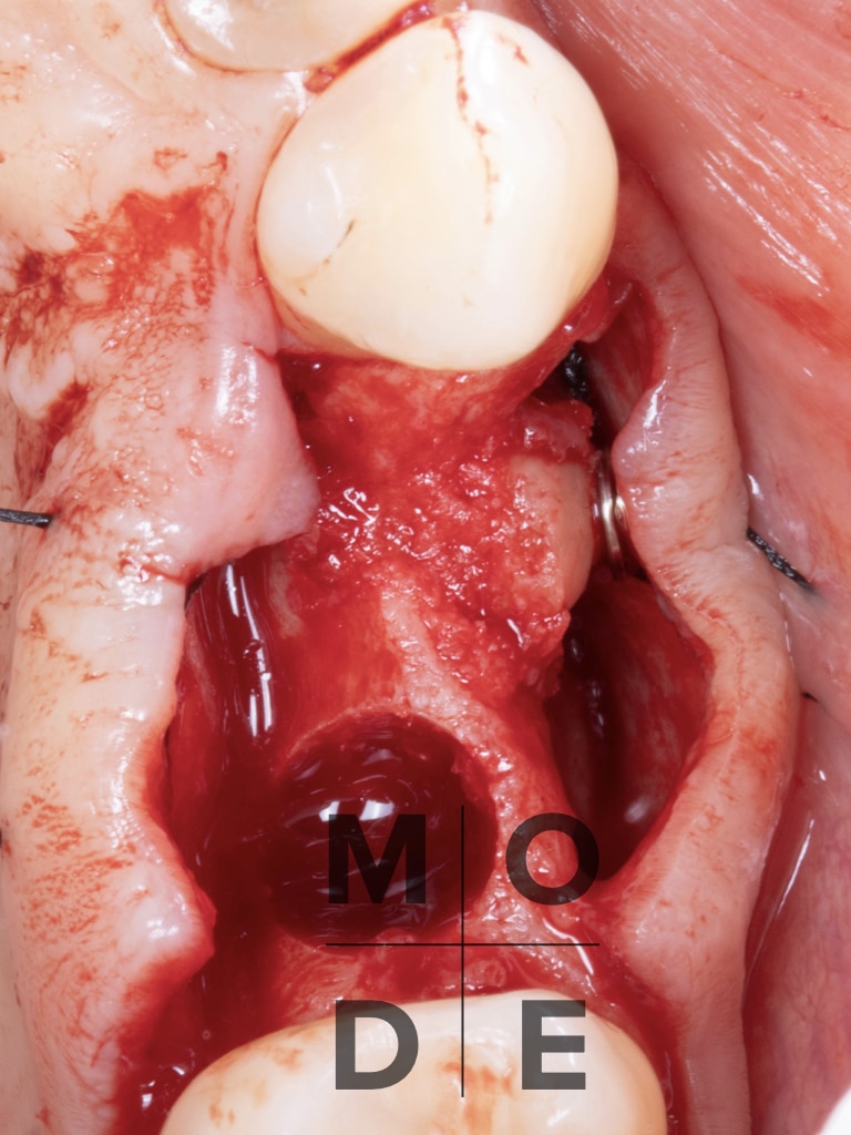 Particulated Bone Graft