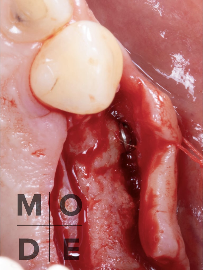 Follow Up at 4 months