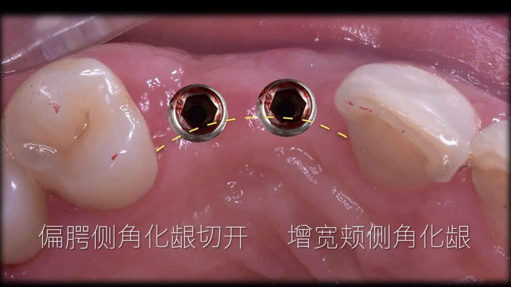 美学区的种植病例比赛.026