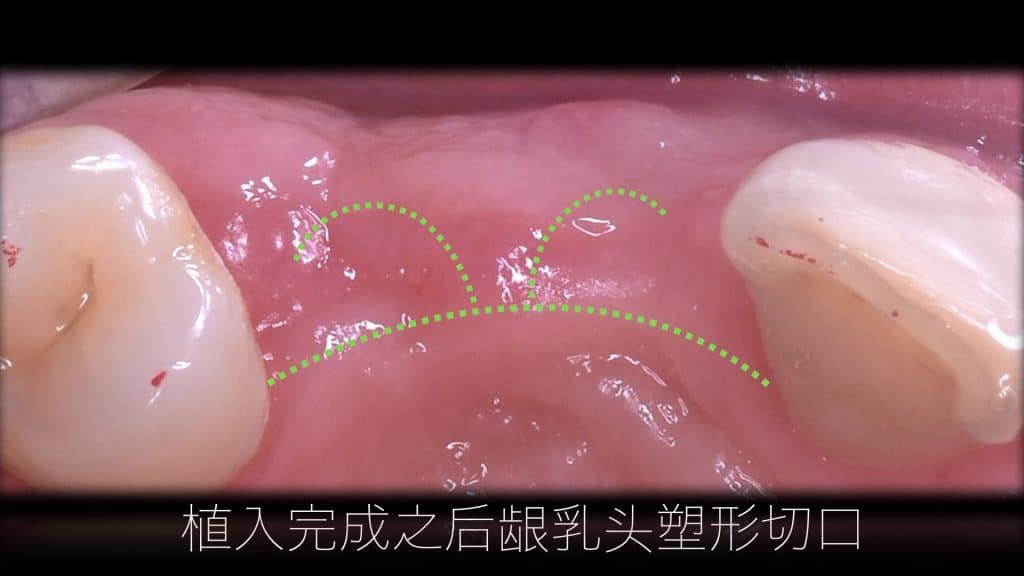 美学区的种植病例比赛.027