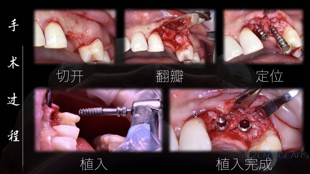 美学区的种植病例比赛.028
