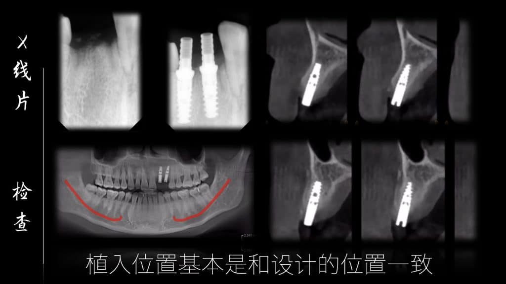 美学区的种植病例比赛.029