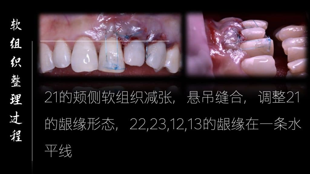 美学区的种植病例比赛.033