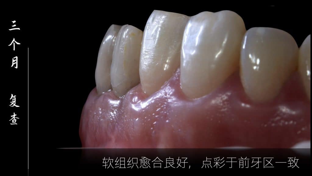 美学区的种植病例比赛.038