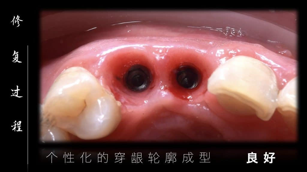 美学区的种植病例比赛.040