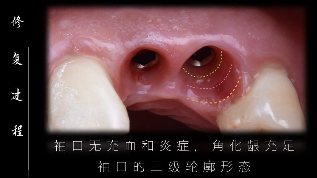 美学区的种植病例比赛.041