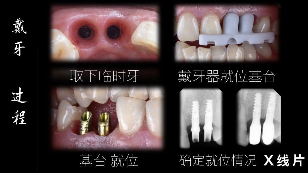 美学区的种植病例比赛.046