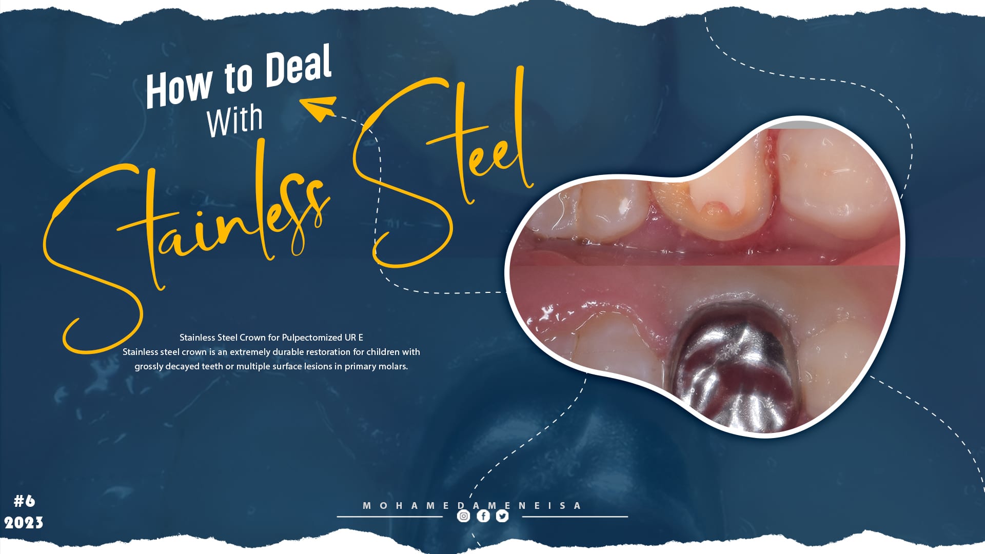 tooth preparation Archives - MyZerodonto