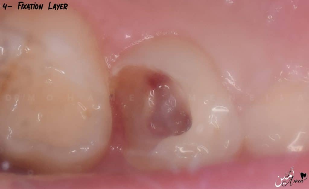 Fixation Layer