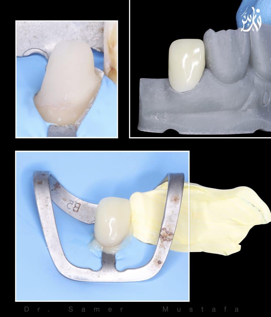 Cementation