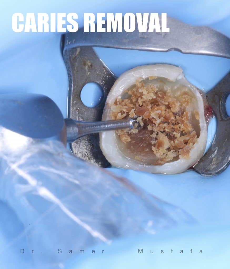 caries removal
