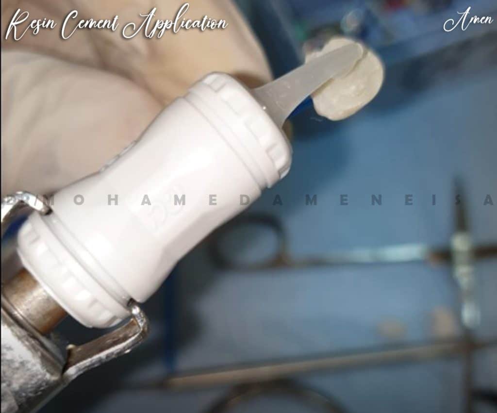 Resin Cement application
