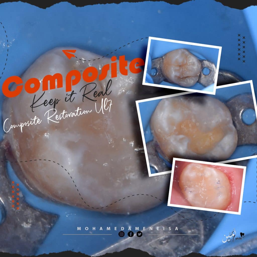 Composite restoration For Upper Left 7