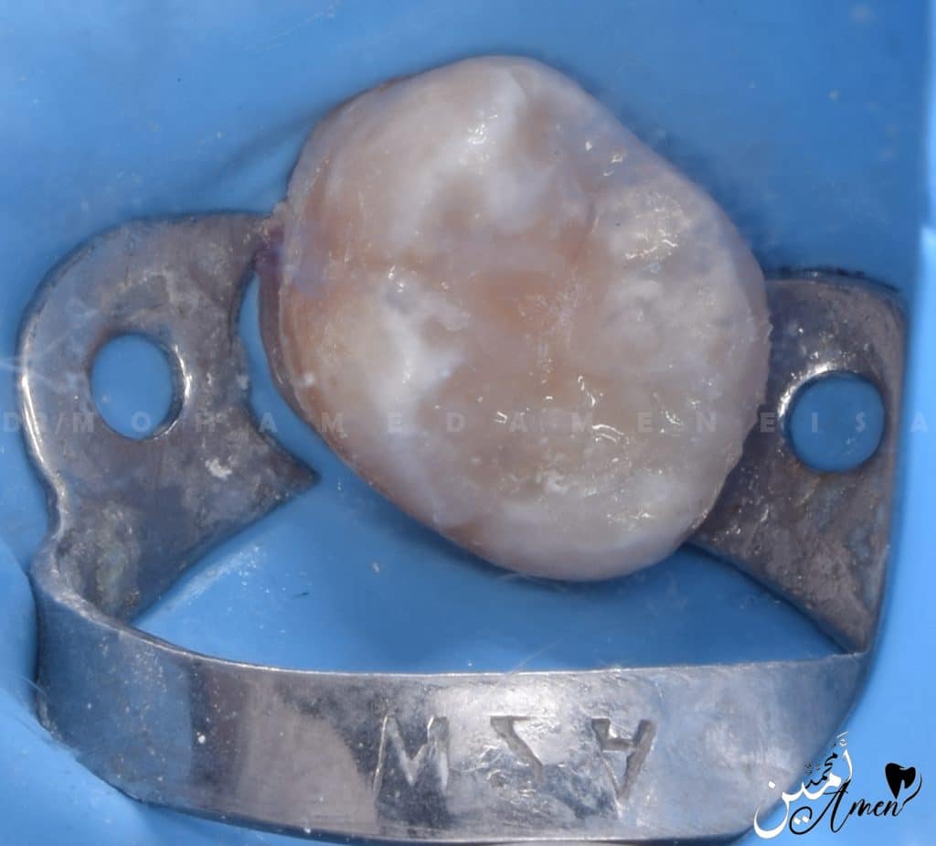 3- Composite Restoration