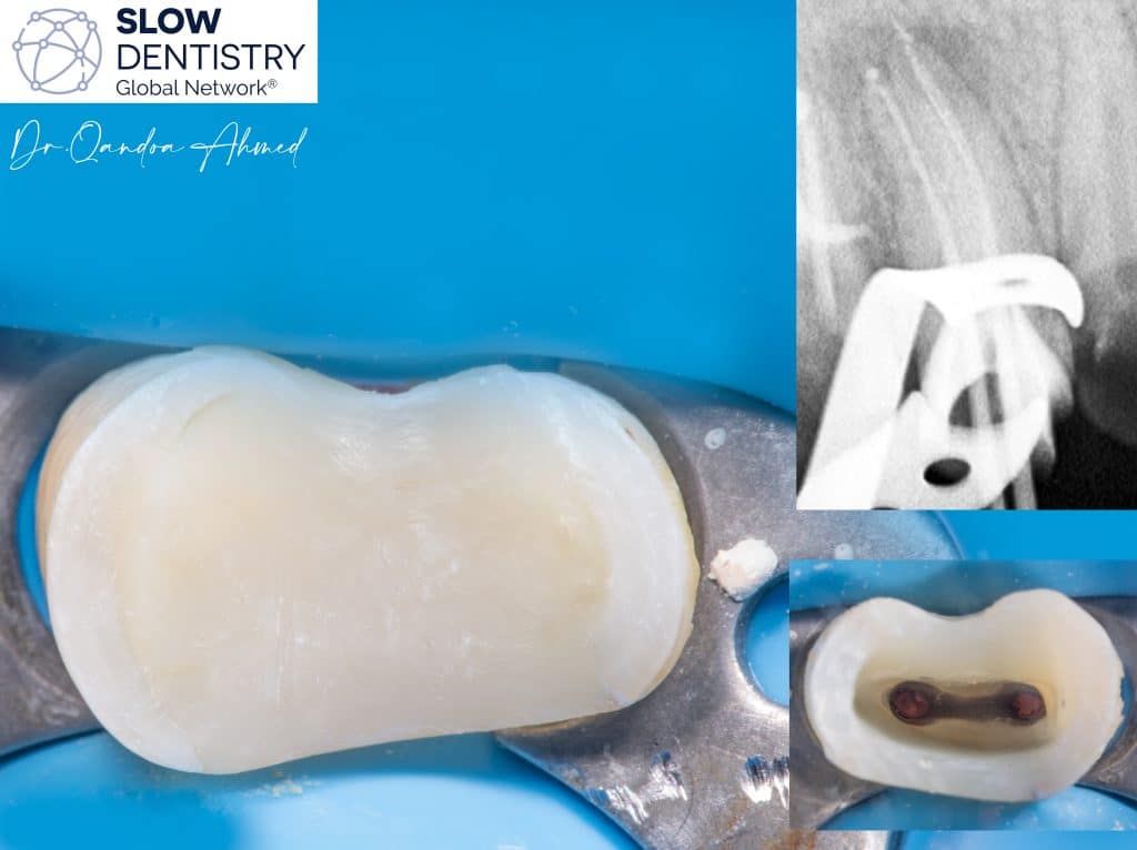 Immediate pre-endodontic dentin sealing , pre-endodontic cavity optimization .