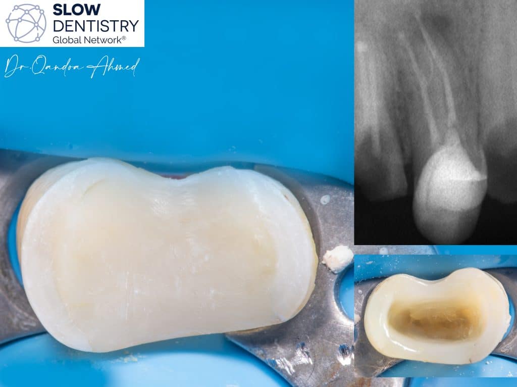 Wall papered by reinforced polyethylene fibers .