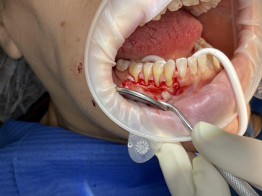 full and split thickness flap