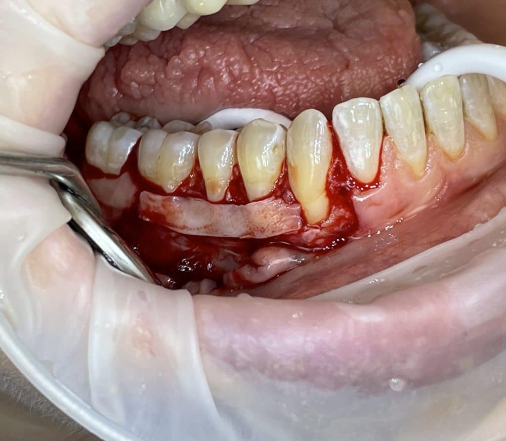connective tissue graft