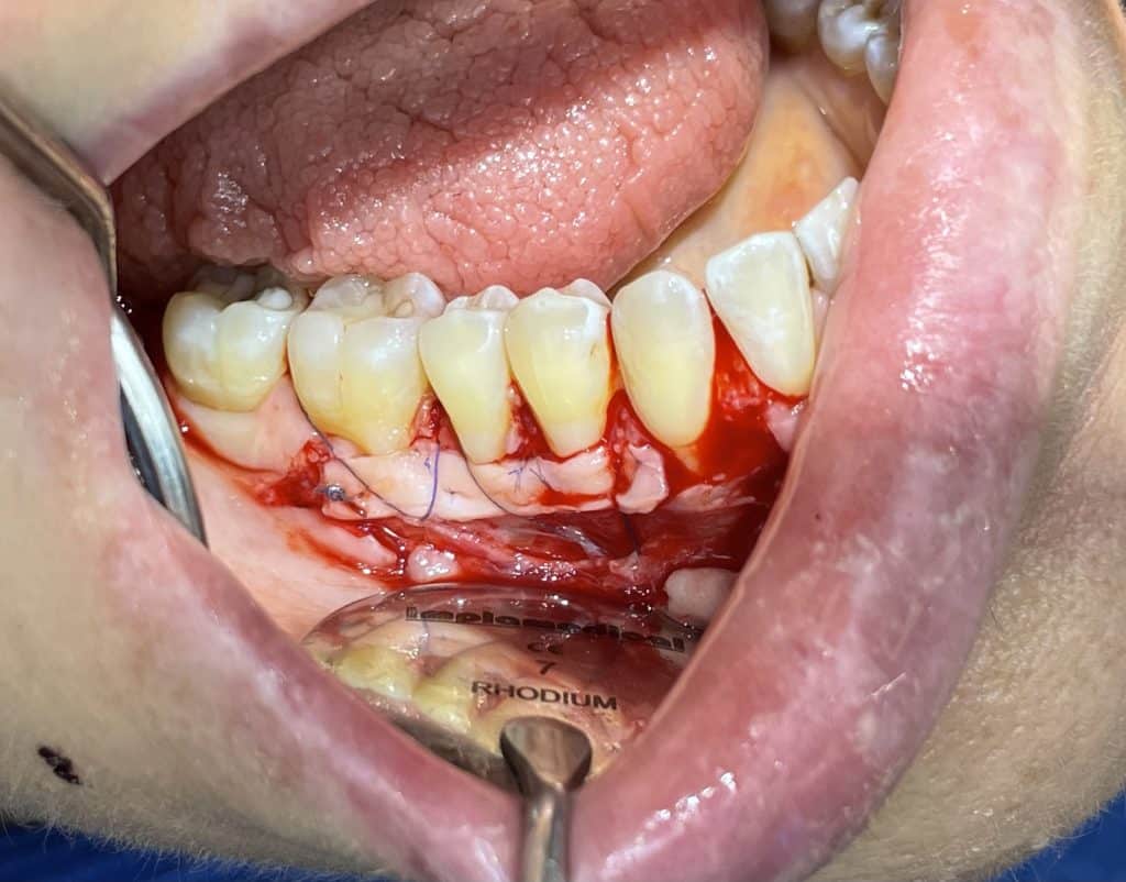 connective tissue graft sutured