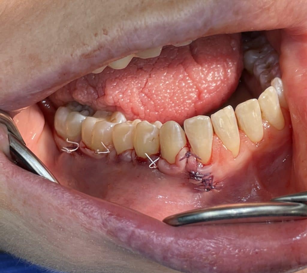 final operative photo