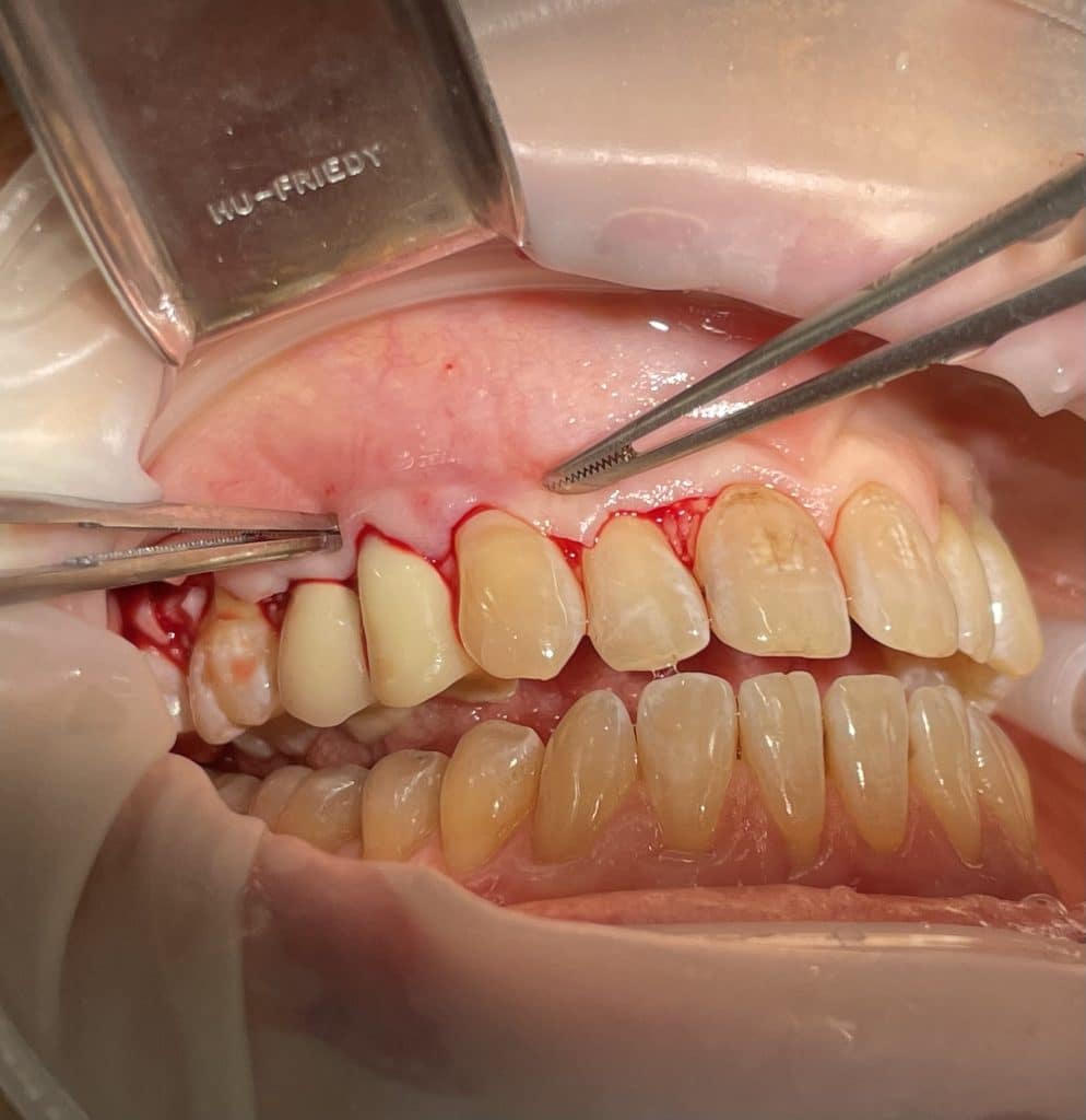 checking the passivity of the covering flap