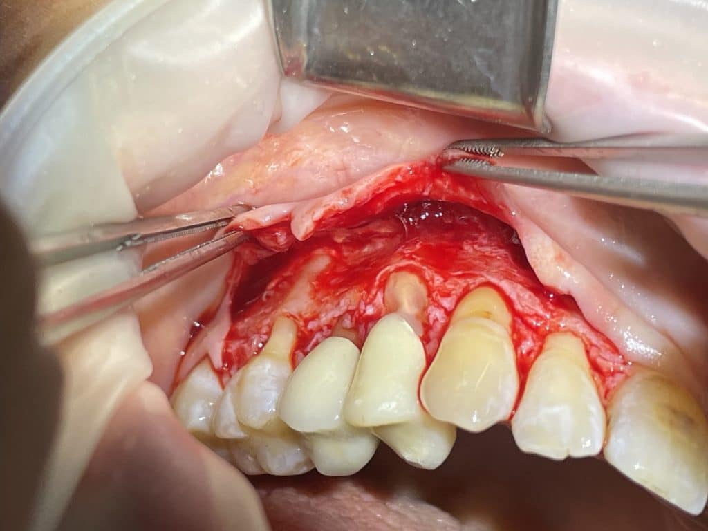 full and split thickness flap